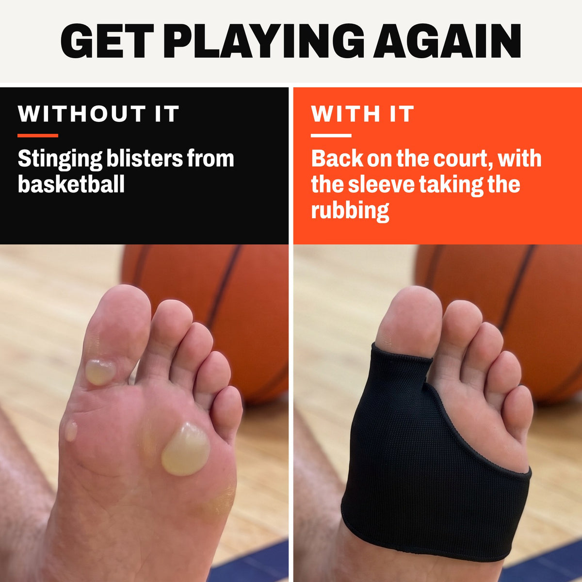 Left, without the sleeve: a forefoot with closed blisters. Right, with it: the same foot wearing the Olyra Blister Sleeve