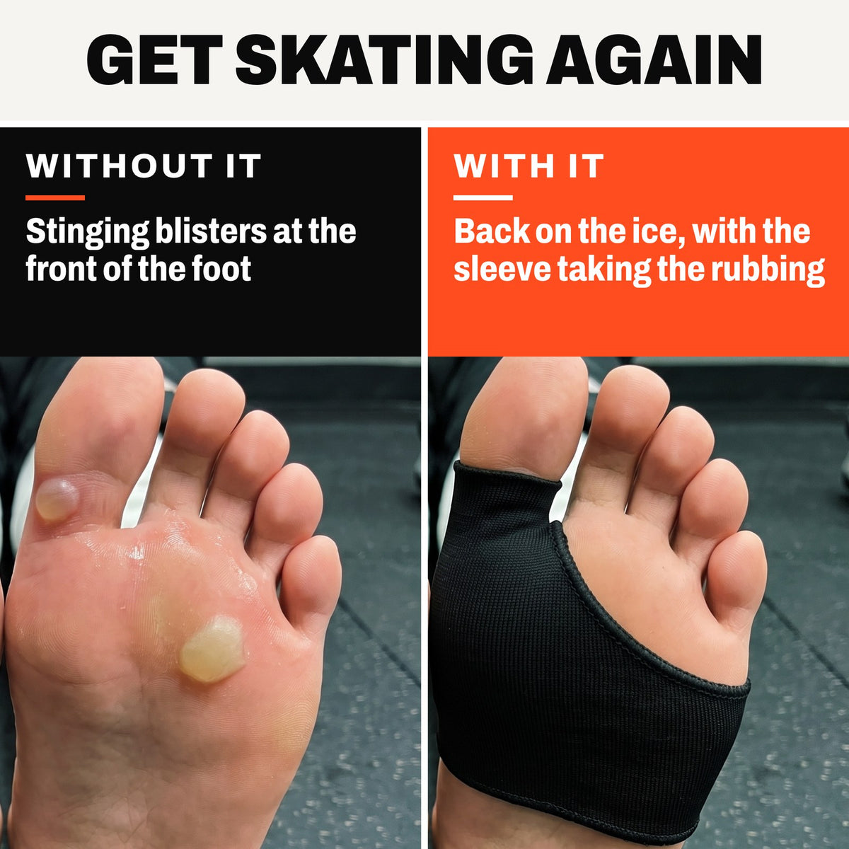Left, without the sleeve: a forefoot with closed blisters. Right, with it: the same foot wearing the Olyra Blister Sleeve