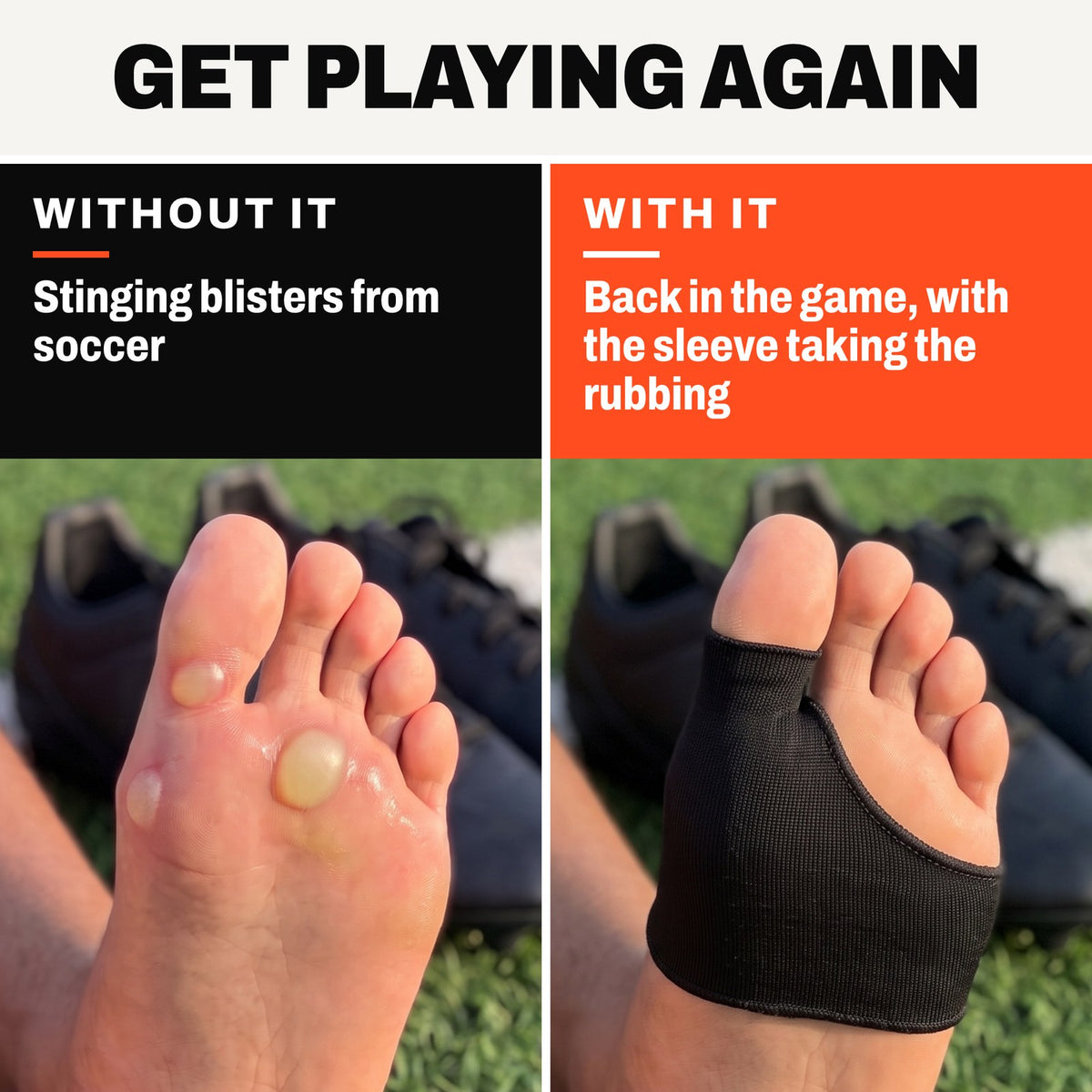 Left, without the sleeve: a forefoot with closed blisters. Right, with it: the same foot wearing the Olyra Blister Sleeve