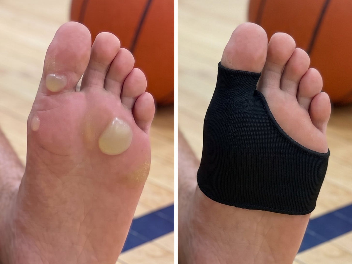 The same foot shown twice: closed blisters on the left, wearing the Olyra Blister Sleeve on the right