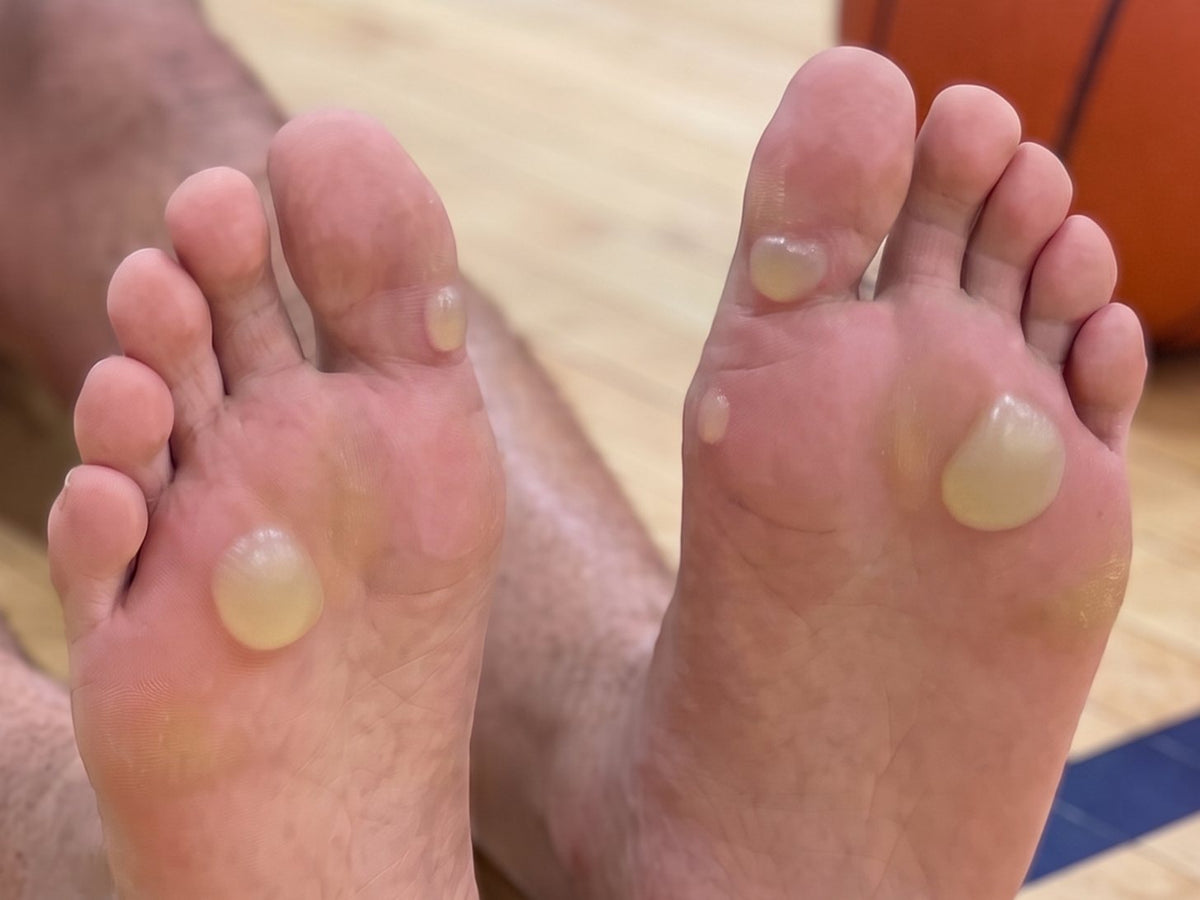 Soles of two feet with closed blisters at the front of the foot