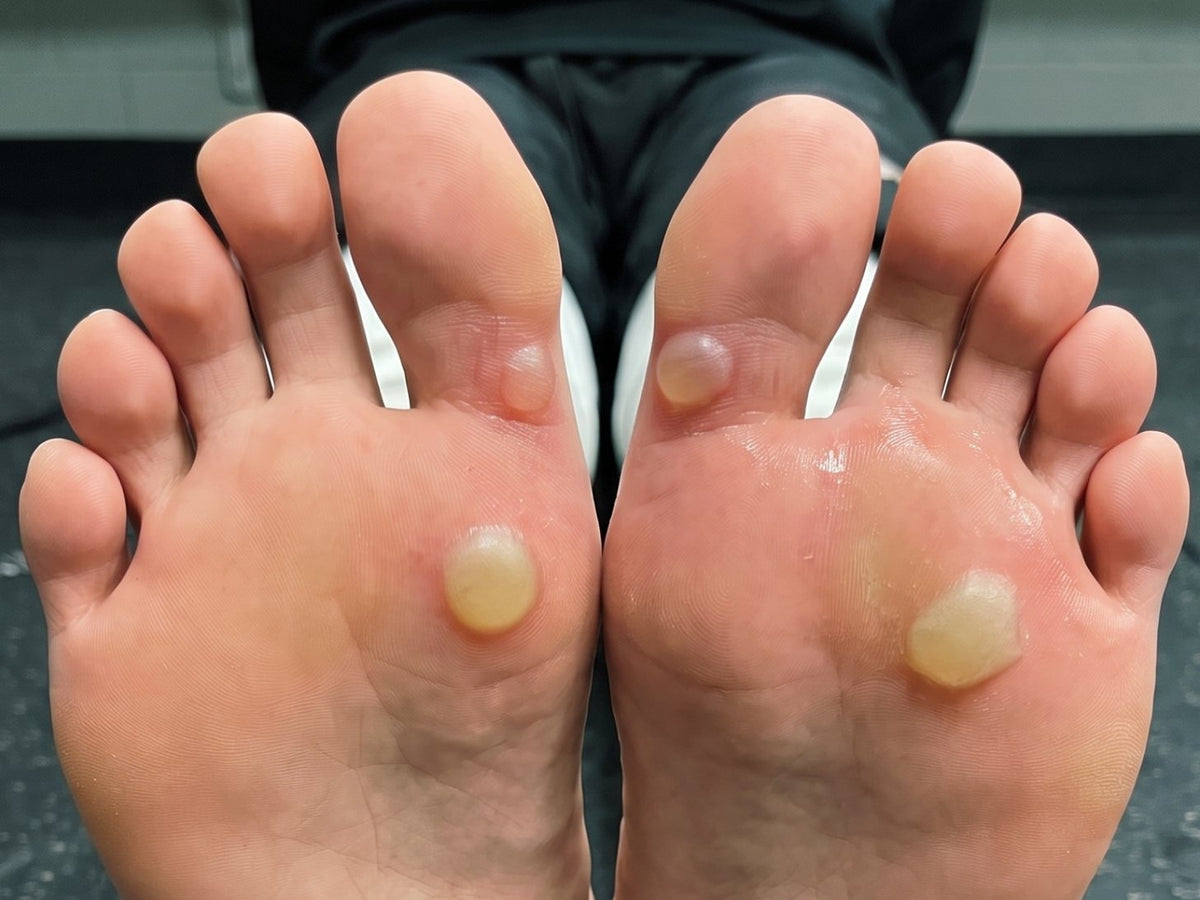Soles of two feet with closed blisters at the front of the foot