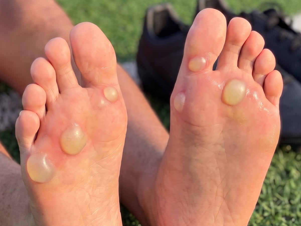 Soles of two feet with closed blisters at the front of the foot